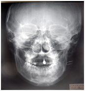 頭蓋骨の歪みの例 噛み合わせ治療