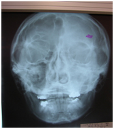 頭蓋骨の歪みの例 かみ合わせ治療