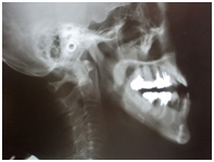 下顎前方位のレントゲン写真